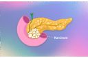 Karcinom pankreasa - kako ga prepoznati i mogućnosti lečenja - eKlinika