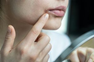 Alergija na balzam za usne: Ovih 6 sastojaka uzrokuju sušenje kože usana