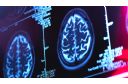 Medicina i nauka: Novi lek protiv Alchajmerove bolesti istorijski pomak, kažu naučnici