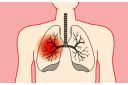 Rak pluća razlikuje se po tipu, a najčešće su 3 vrste karcinoma - eKlinika