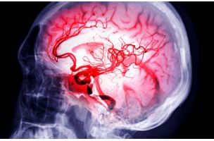 Disekcija cervikalne arterije čest je uzrok moždanog udara kod mlađih ljudi - eKlinika