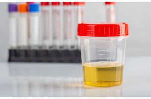 Novi test urina mogao bi da otkrije rak jajnika u ranoj fazi: Nanotehnologijom detektovani specifični peptidi - eKlinika
