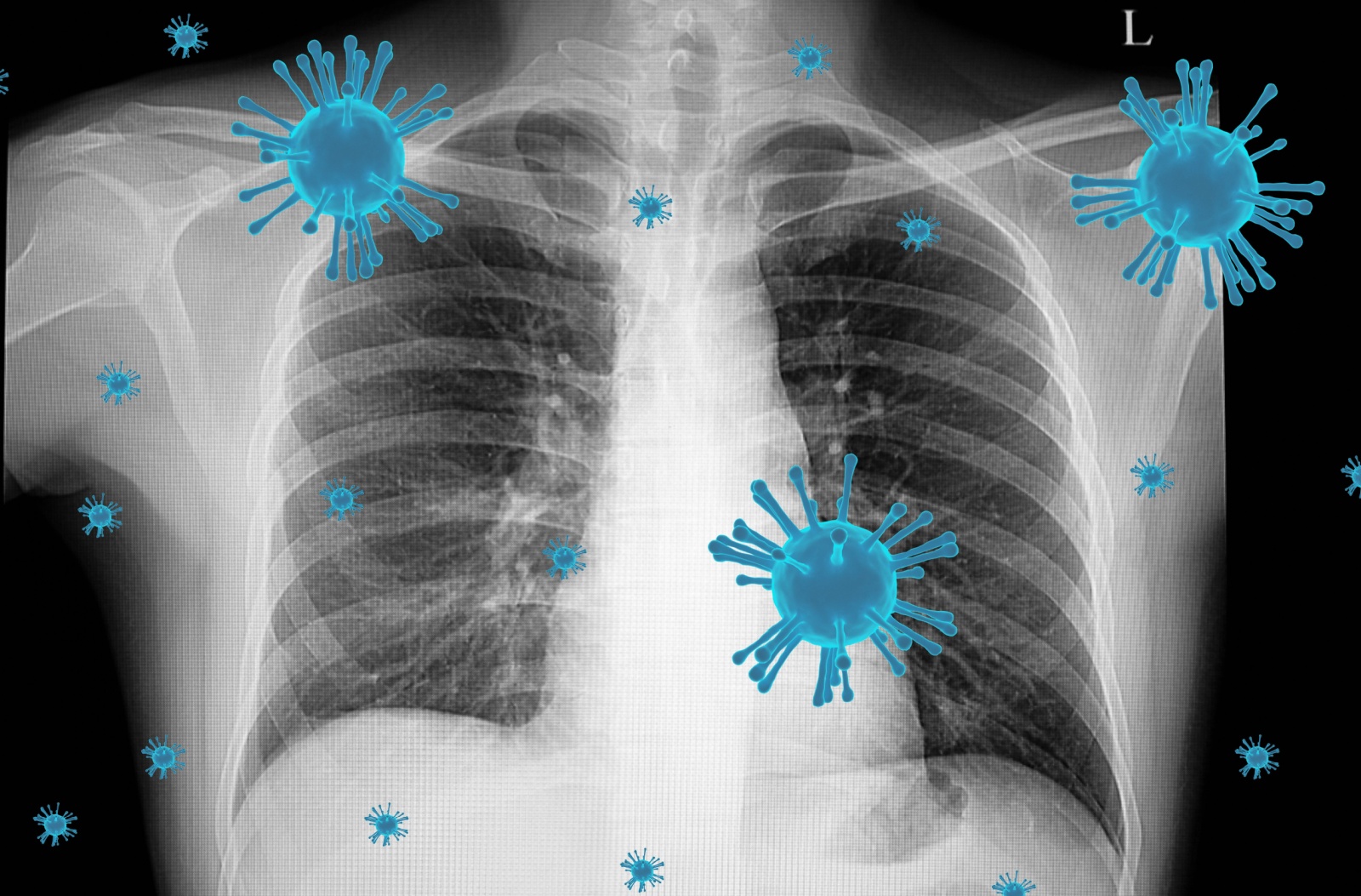 Otkriveno da teška infekcija pluća usled covid 19 infekcije može da izazove oštećenje srca - eKlinika