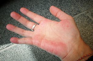 Pogledajte svoje ruke: Crvenilo, žuljevi... mogu biti znaci ozbiljnih bolesti